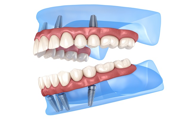 All On   : Replace All Top Teeth In A Day