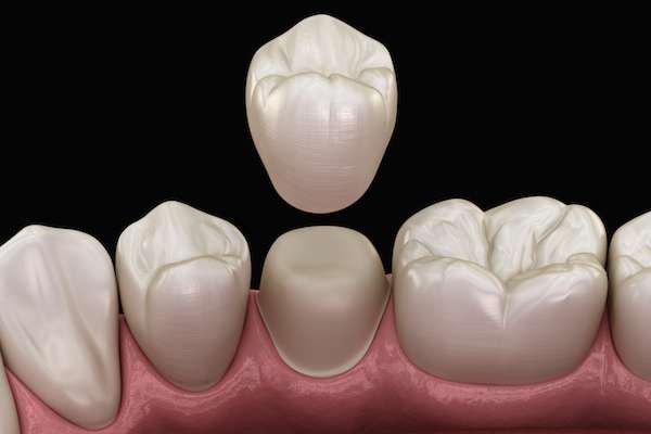 What To Ask Your General Dentist When Preparing for a Crown from Relax and Smile Dental Care in Miami, FL