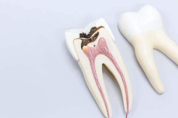 Ask a General Dentist: Is a Tooth Dead After a Root Canal from Relax and Smile Dental Care in Miami, FL