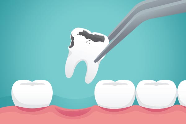 Ask a General Dentist: What Happens to Your Tooth After Extraction from Relax and Smile Dental Care in Miami, FL