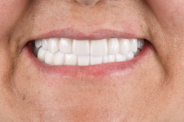 Is Dental Bonding A Cosmetic Dental Procedure?