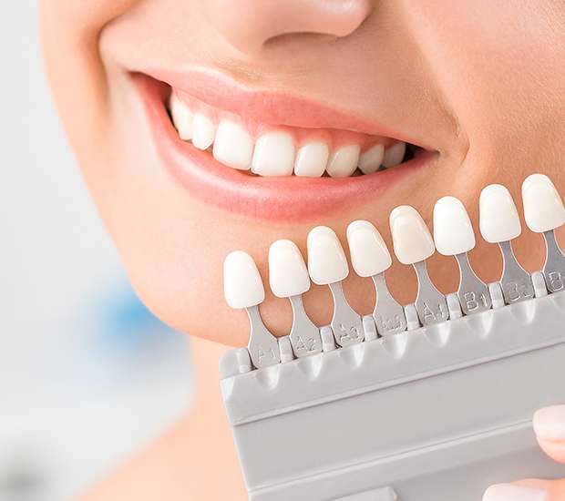 Miami Dental Veneers and Dental Laminates