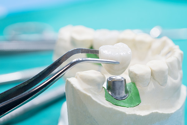 General Dentistry Solutions Using Dental Crowns from Relax and Smile Dental Care in Miami, FL