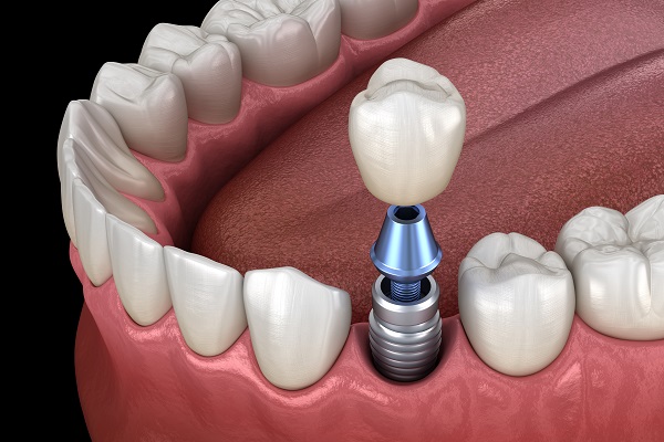 Implant Supported Denture Miami, FL