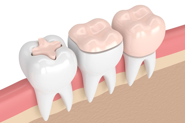 What Type Of Materials Are Used In Dental Restorations?